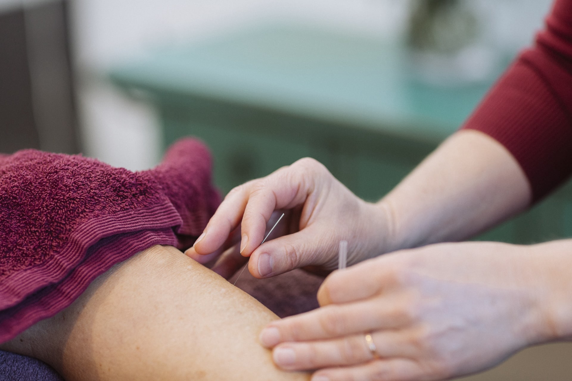 Close up therapist hands treating patient with acupunture